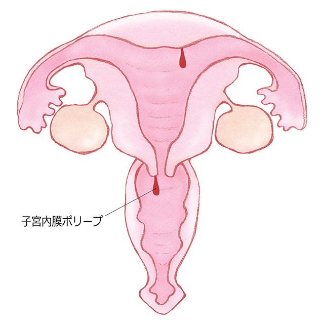 子宮頸管ポリープ／子宮内膜ポリープ